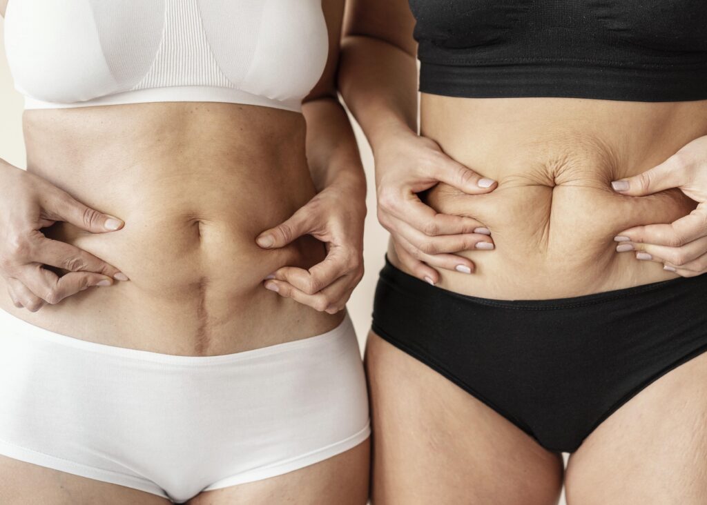 Abdominoplastie